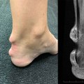 Understanding and Managing Ankle Pain in Autoimmune Diseases