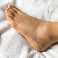 Ankle Injuries: Causes, Types, and Treatment