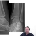 Understanding the Importance of the Tibiofibular and Talocrural Joints in Ankle Health