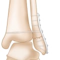 The Complex Anatomy of the Ankle Bones