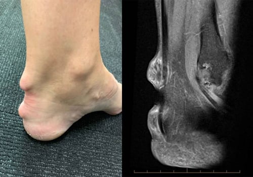 Understanding and Managing Ankle Pain in Autoimmune Diseases