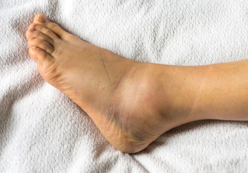 Ankle Injuries: Causes, Types, and Treatment