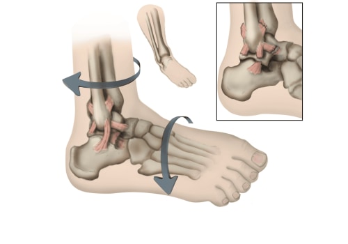 Ankle Sprains: How to Determine Severity and Seek Treatment