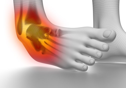 Ankle Sprains: Understanding the Most Prone Side to Injury