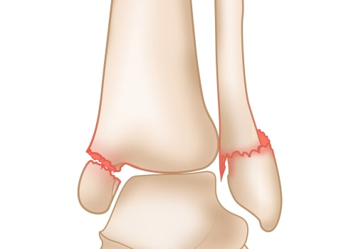 The Fascinating Anatomy of the Outer Ankle