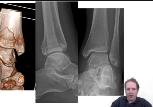 Understanding the Importance of the Tibiofibular and Talocrural Joints in Ankle Health