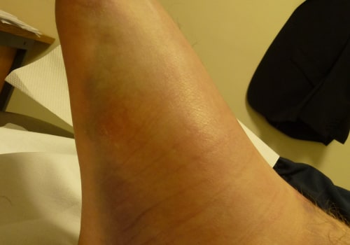 Ankle Sprains: Understanding Grades 2 and 3 - From an Expert's Perspective