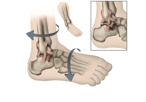 Ankle Sprains: Understanding the Causes, Treatment, and Prevention