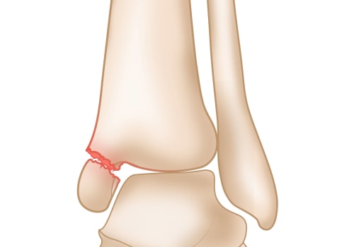 The Complex Anatomy of the Ankle