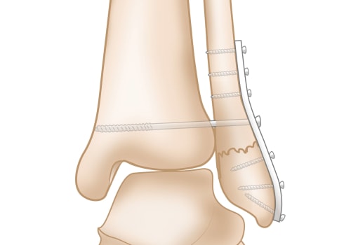 The Complex Anatomy of the Ankle Bones